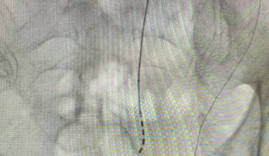 Imagen de una intervención empleando neuromodulación de raíces sacras.