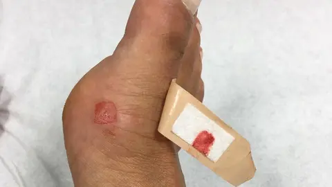 Imagen del pie de la persona que fue mordida por la rata.