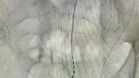 Imagen de una intervención empleando neuromodulación de raíces sacras.