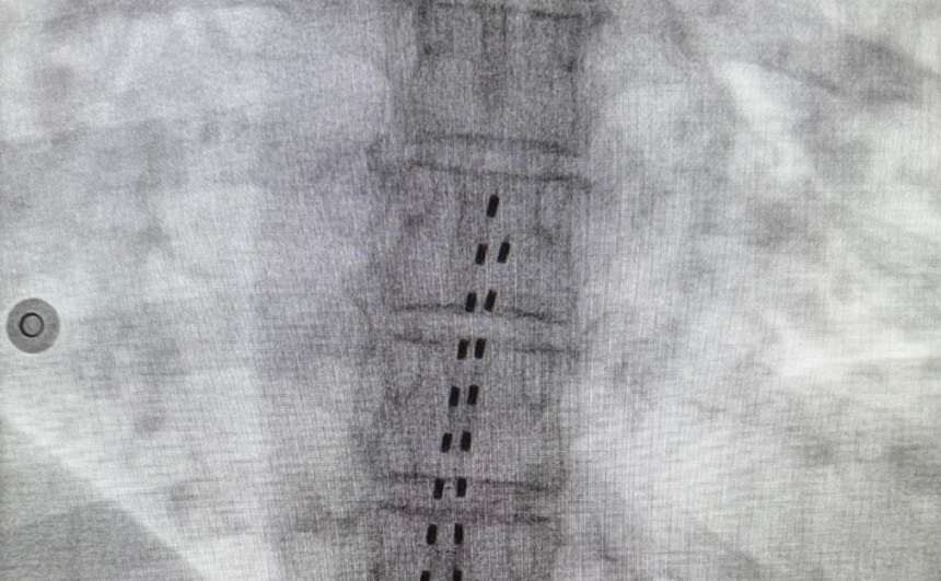 Imagen de la neuromodulación medular 2